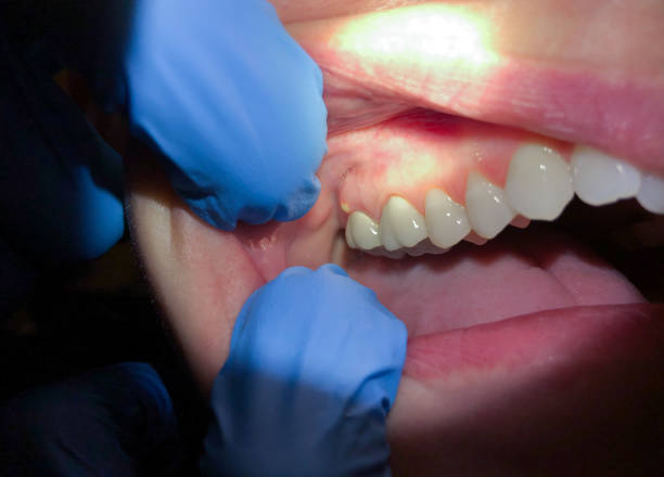 Best Emergency Root Canal Treatment in Abernathy, TX