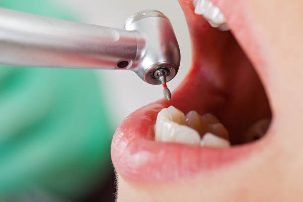 Best Emergency Dental Extractions in Abernathy, TX